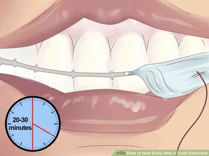 Image intitulée Guérir les Gencives Après une Extraction de Dent de l